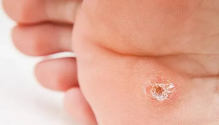 Подошвенная бородавка