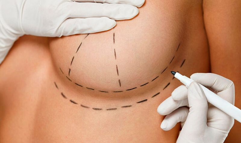 Пластика груди в Турции